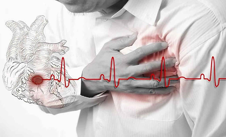 Đau thắt ngực ổn định không được điều trị có thể tăng nguy cơ đau tim