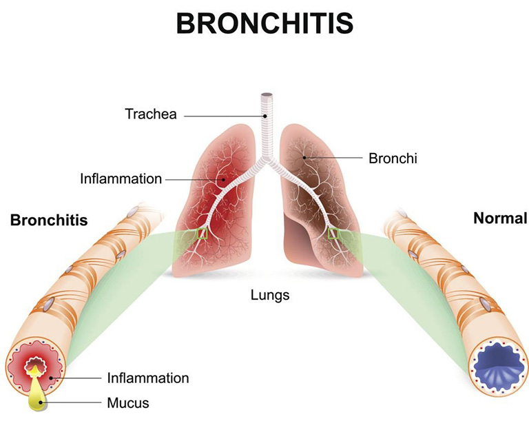 hít thở sâu bị đau sườn trái hoặc phải