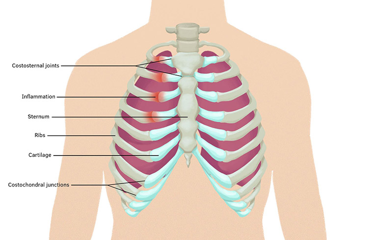 Hít thở sâu bị đau sườn phải