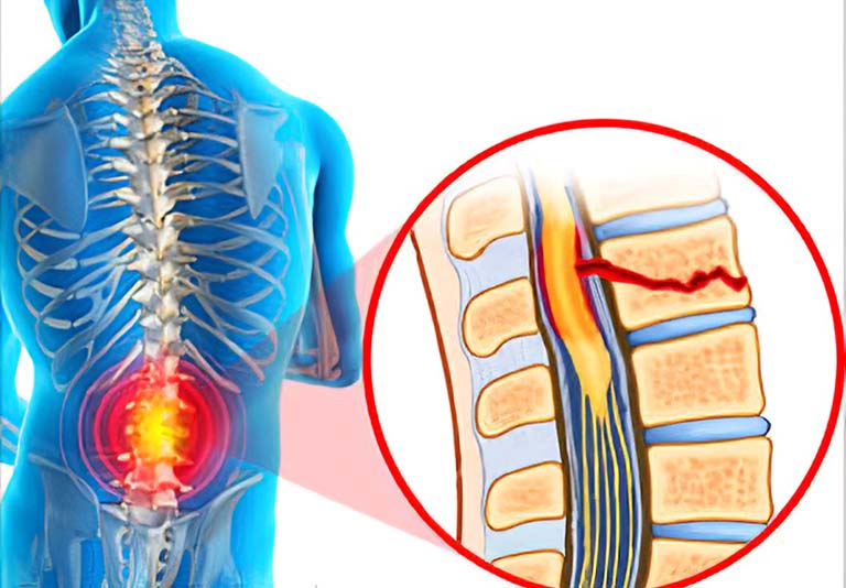 Chấn thương tủy sống có thể là chấn thương hoàn toàn hoặc không hoàn toàn