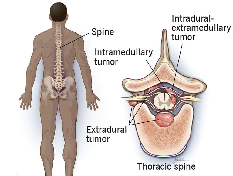 Ung thư cột sống với khối u chèn ép vào tủy sống