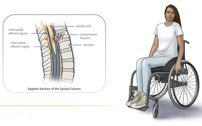 Bại liệt hoặc giảm khả năng vận động khi bị chấn thương tủy sống