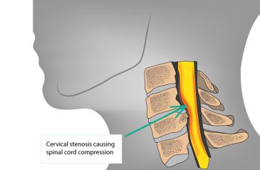 hẹp đốt sống cổ