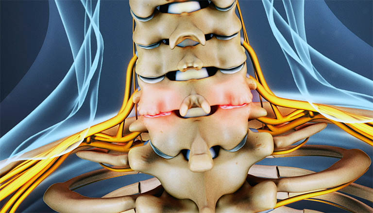 Nguyên nhân gây hẹp lỗ liên hợp cột sống cổ