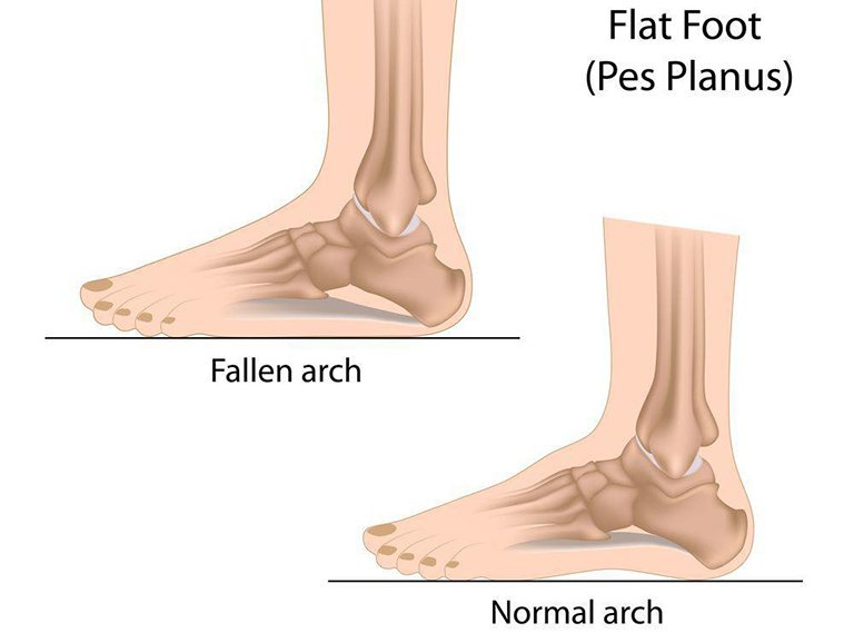 Hội chứng bàn chân phẳng