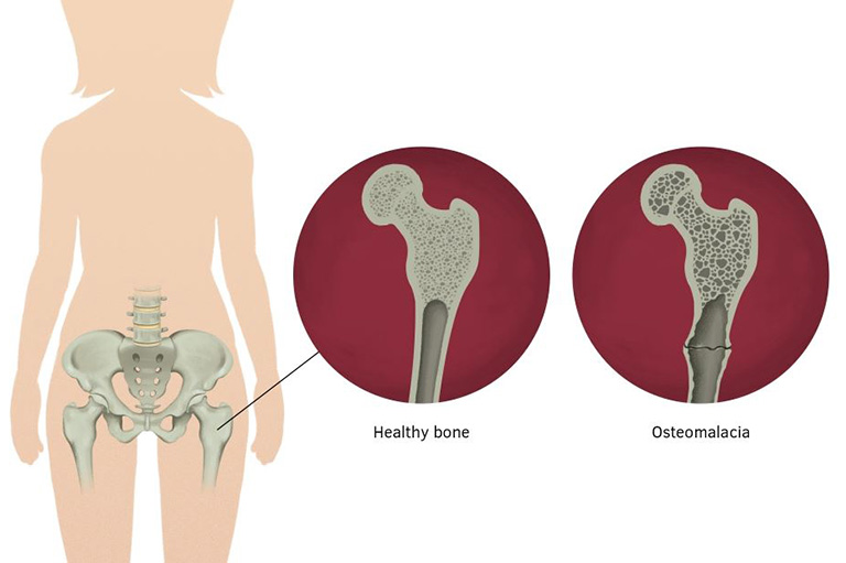 Bệnh nhuyễn xương
