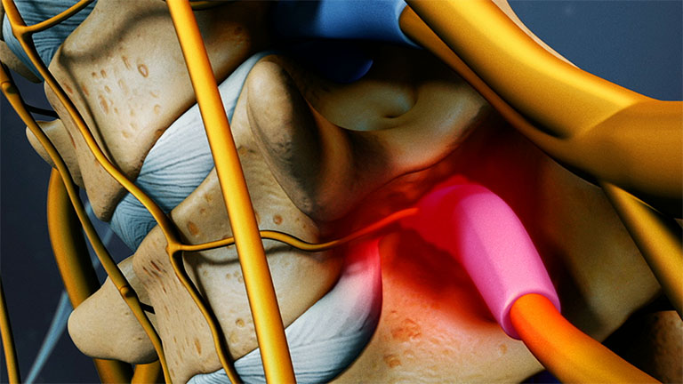 Người nên phẫu thuật hẹp ống sống lưng