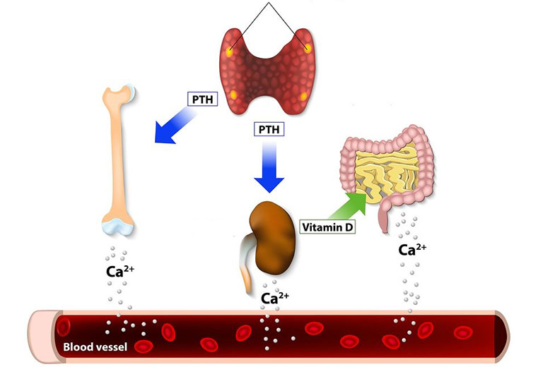 tăng canxi huyết