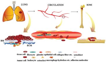 ung thư phổi di căn xương