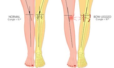 chân vòng kiềng có cao được không