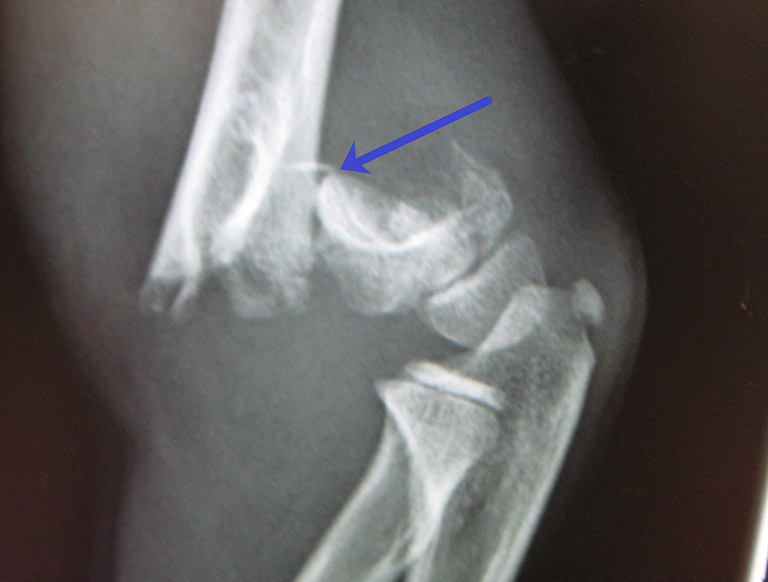 Chụp X-quang chẩn đoán gãy trên lồi cầu xương cánh tay