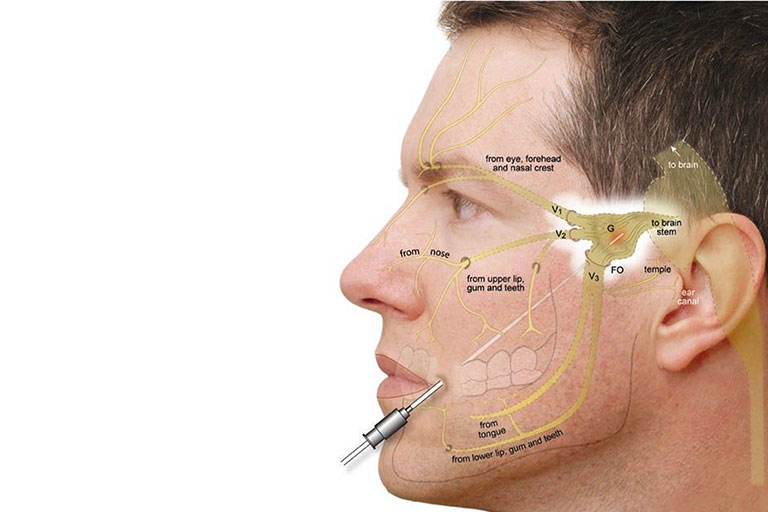 Đường đi của dây thần kinh số 5