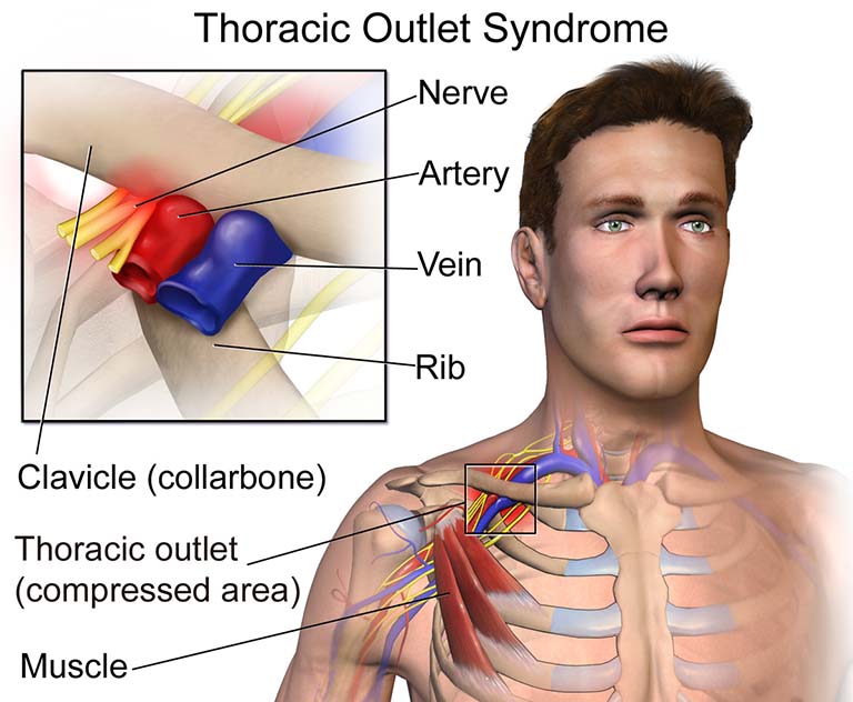 Hội chứng lối thoát ngực (TOS)