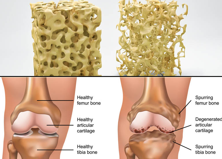 Phân biệt loãng xương và thoái hóa khớp