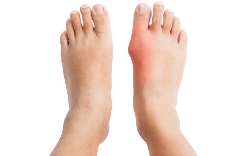 đông trùng hạ thảo với bệnh gout