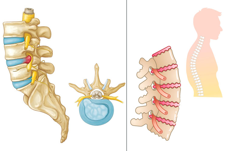 Phân biệt thoái hóa đốt sống và thoát vị đĩa đệm