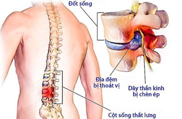 Giải Đáp Vấn Đề Thoát Vị Đĩa Đệm Có Nguy Hiểm Không?