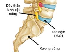 Bệnh Thoát Vị Đĩa Đệm Mông: Dấu Hiệu, Biến Chứng, Cách Chữa