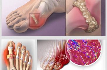 Bệnh Gout Có Di Truyền Không? Hướng Dẫn Cách Phòng Ngừa