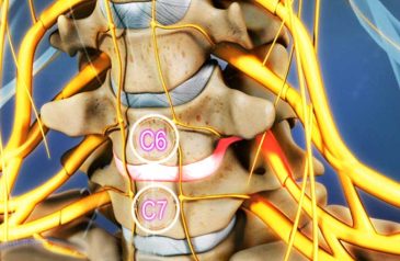 Thoát Vị Đĩa Đệm Đốt Sống Cổ C6 C7: Dấu Hiệu, Cách Chữa