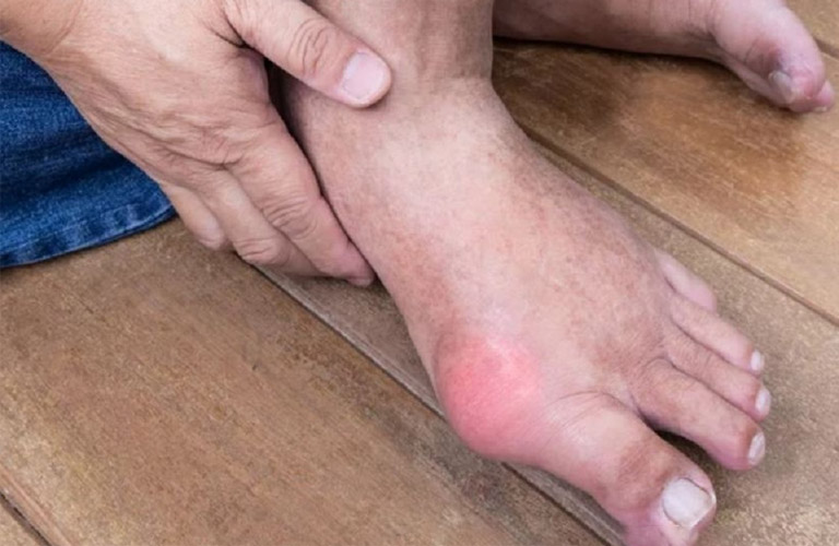 Chuyên gia cho biết bệnh gout có tính di truyền