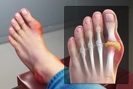 Bệnh Gout Ở Bàn Chân: Nguyên Nhân, Dấu Hiệu Và Cách Chữa