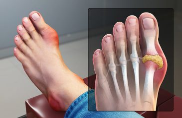 Bệnh Gout Ở Bàn Chân: Nguyên Nhân, Dấu Hiệu Và Cách Chữa