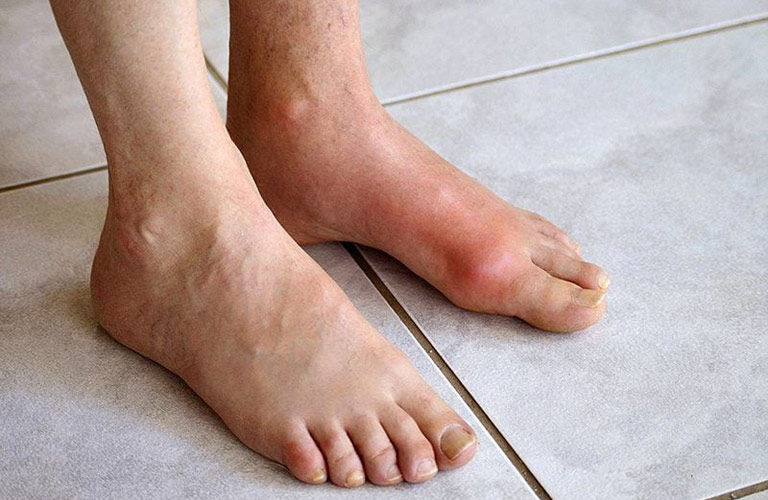 Có nhiều nguyên nhân dẫn đến gout ở bàn chân